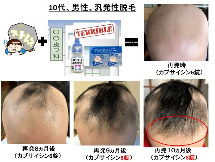 円形脱毛症　病院